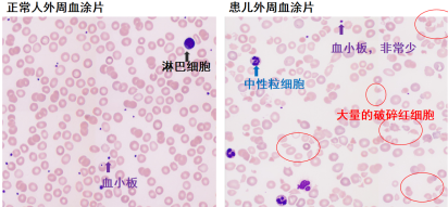 依库珠单抗，儿童非典型溶血尿毒综合征（a